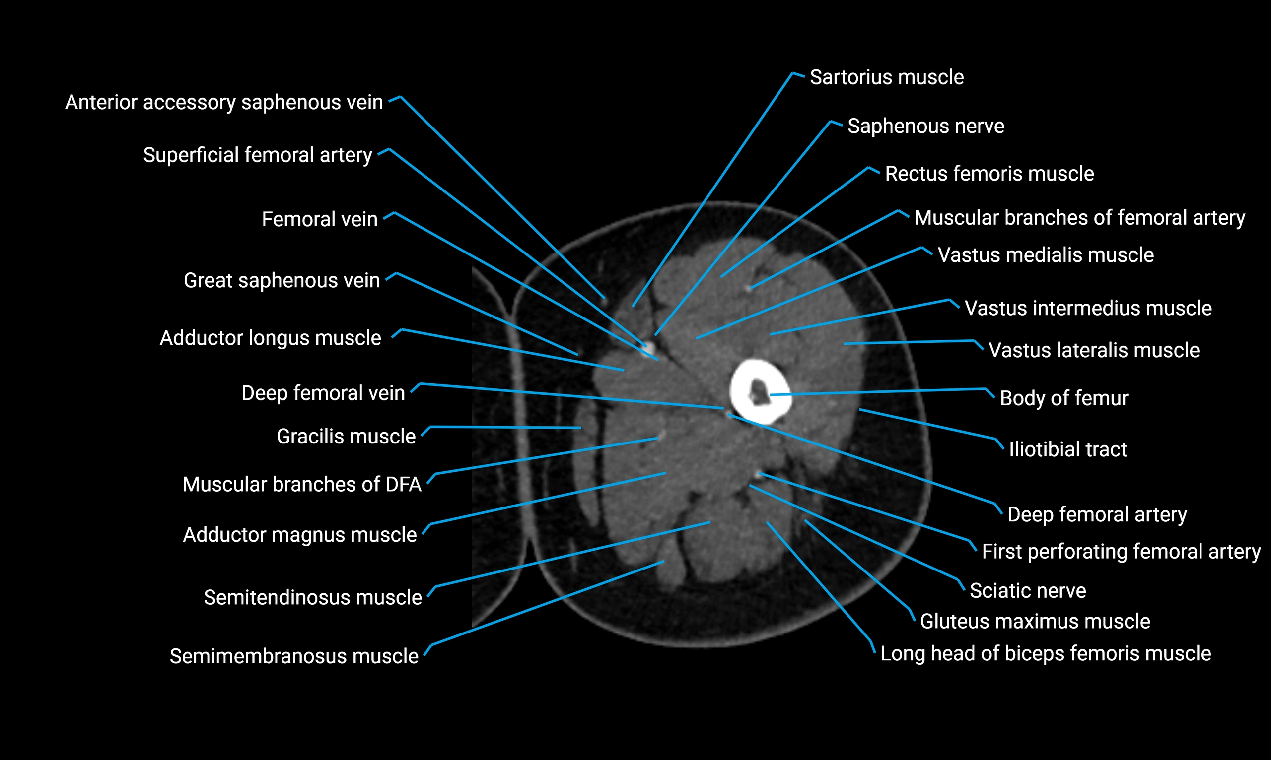 CT lower limb axial cross sectional anatomy labelled image 37 (2).webp